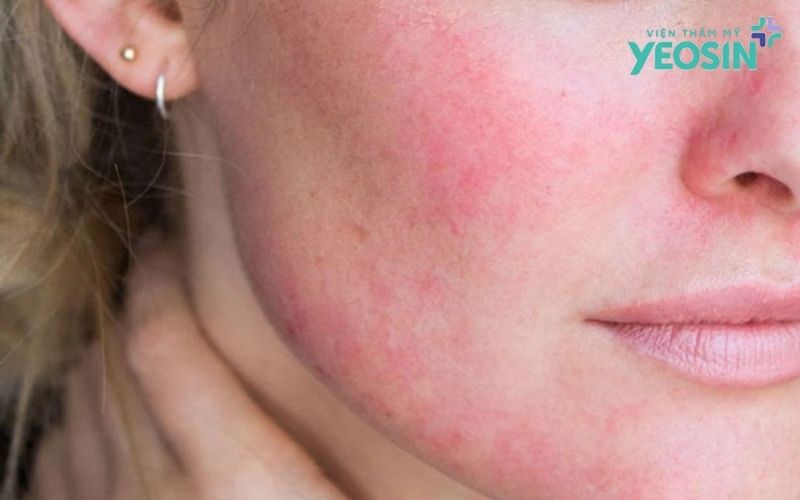 Tiêm meso bị ngứa, sưng đỏ có nguy hiểm không?