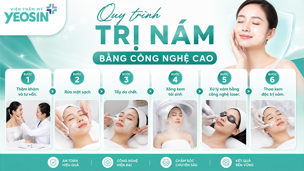 Da mặt bị nám - Tìm hiểu nguyên nhân gây nám da mặt. 10 Quy trình điều trị nám bằng phương pháp laser đúng chuẩn y khoa