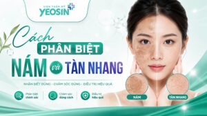 Cách phân biệt nám và tàn nhang đồi mồi đơn giản