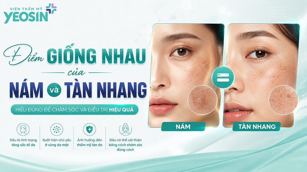 Điểm giống nhau của nám và tàn nhang