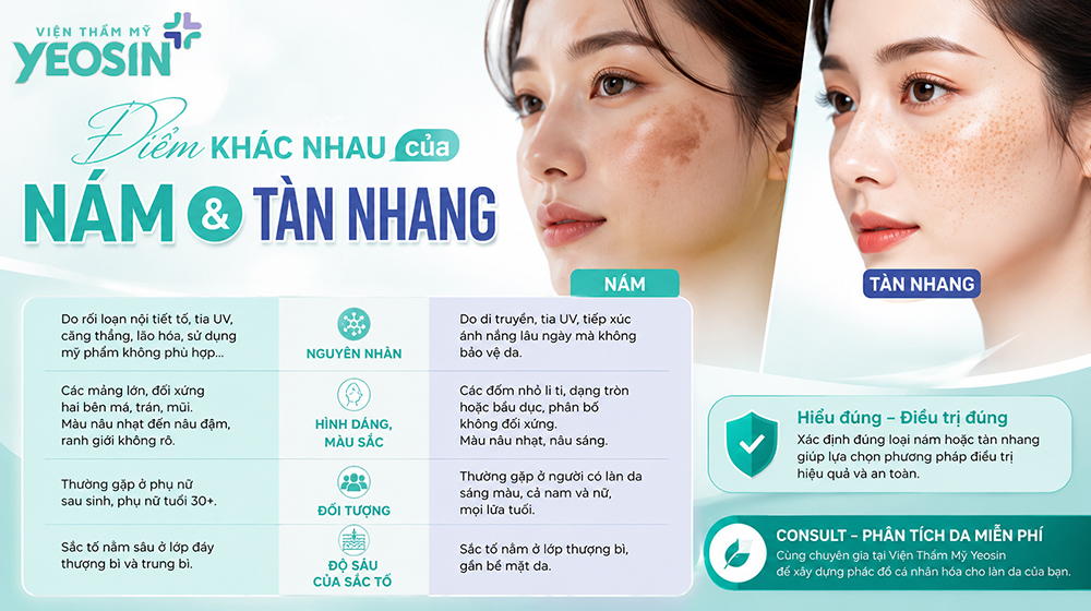 Điểm khác nhau để phân biệt nám và tàn nhang