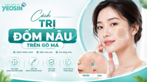 Cách trị đốm nâu trên gò má hiệu quả