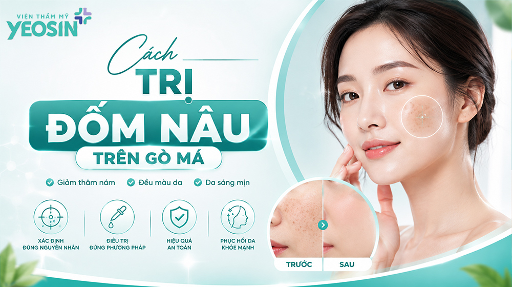 Cách trị đốm nâu trên gò má hiệu quả