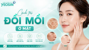 Cách điều trị đồi mồi ở mặt hiệu quả và an toàn
