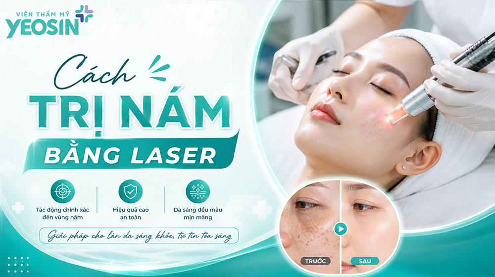 Cách trị nám hiệu quả bằng công nghệ Laser