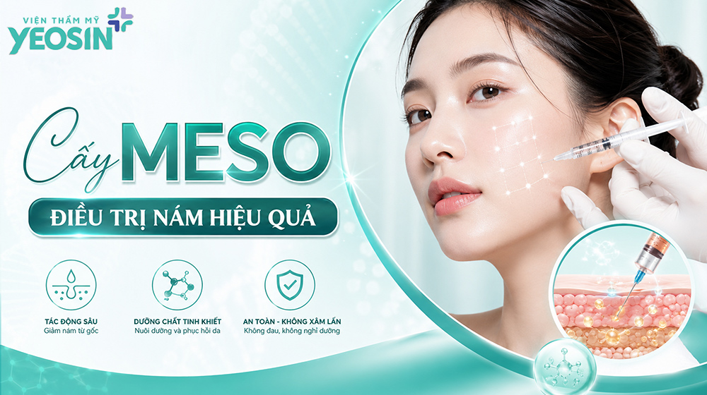 Cấy meso điều trị nám hiệu quả
