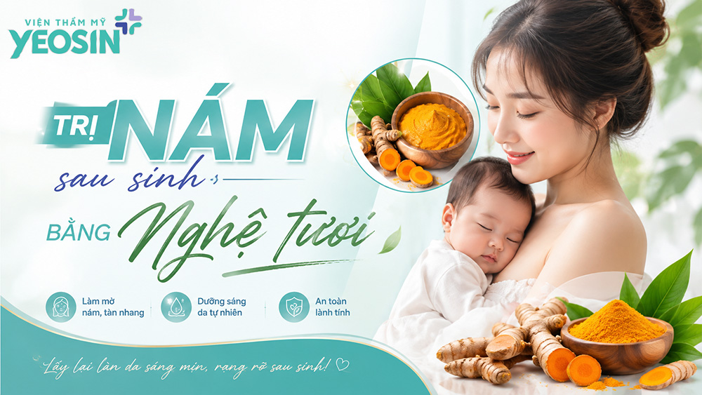 cách trị nám sau sinh bằng nghệ tươi