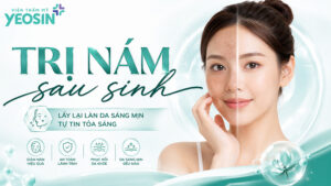 Cách trị nám sau sinh an toàn và hiệu quả