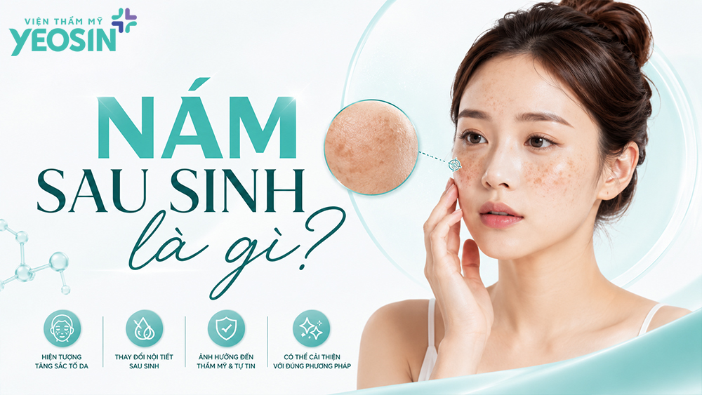 Cách trị nám sau sinh an toàn và hiệu quả 8 Nám sau sinh là gì?