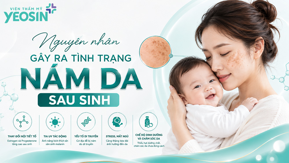 Cách trị nám sau sinh an toàn và hiệu quả 9 Nguyên nhân gây ra tình trạng nám da sau sinh