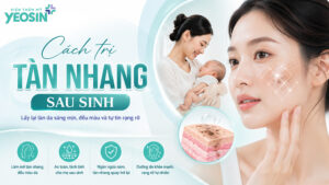 cách trị tàn nhang sau sinh hiệu quả