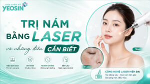 Điều trị nám bằng laser và những điều cần biết về laser nám