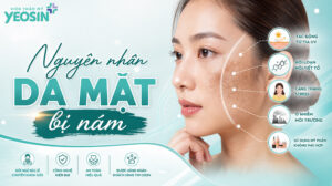 Da mặt bị nám - Tìm hiểu nguyên nhân gây nám da mặt.