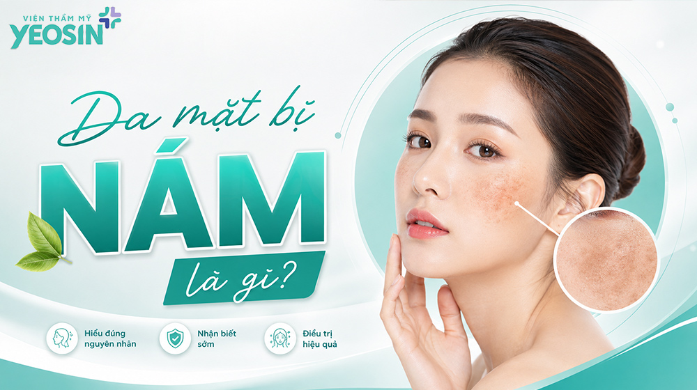 Da mặt bị nám - Tìm hiểu nguyên nhân gây nám da mặt. 6 Da mặt bị nám là gì?
