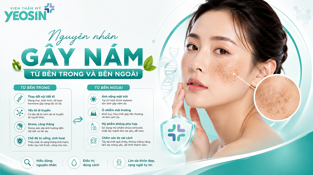 Da mặt bị nám - Tìm hiểu nguyên nhân gây nám da mặt. 7 Nguyên nhân khiến da mặt bị nám là gì?