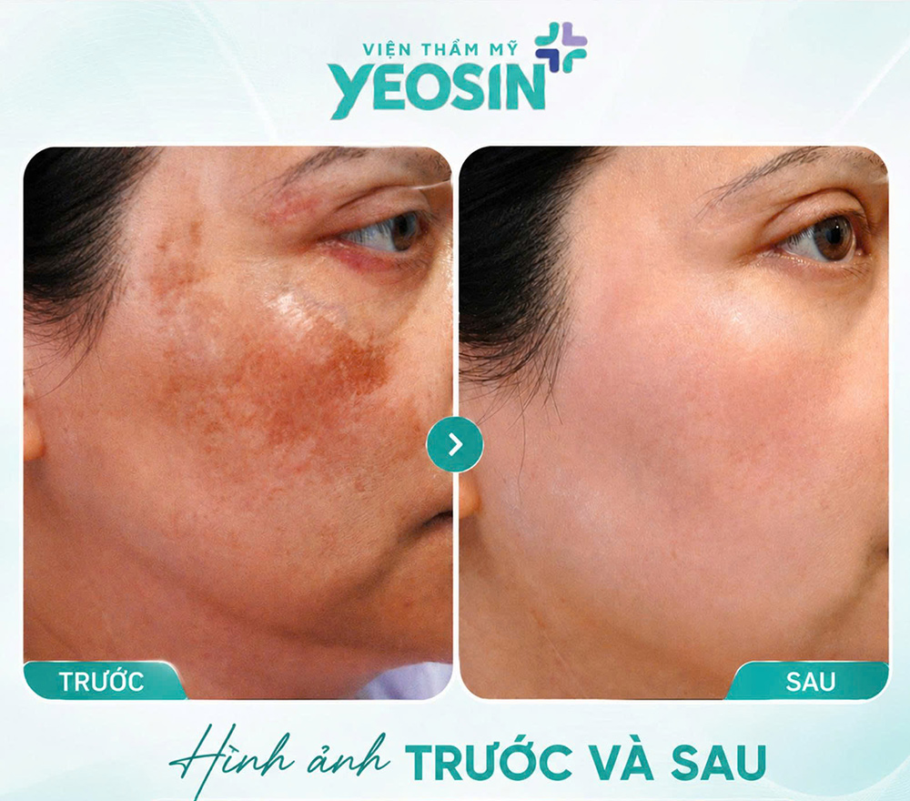Điều trị nám bằng laser và những điều cần biết về laser nám 13 Hình ảnh trước và sau khi trị nám tàn nhang bằng laser tại Yeosin