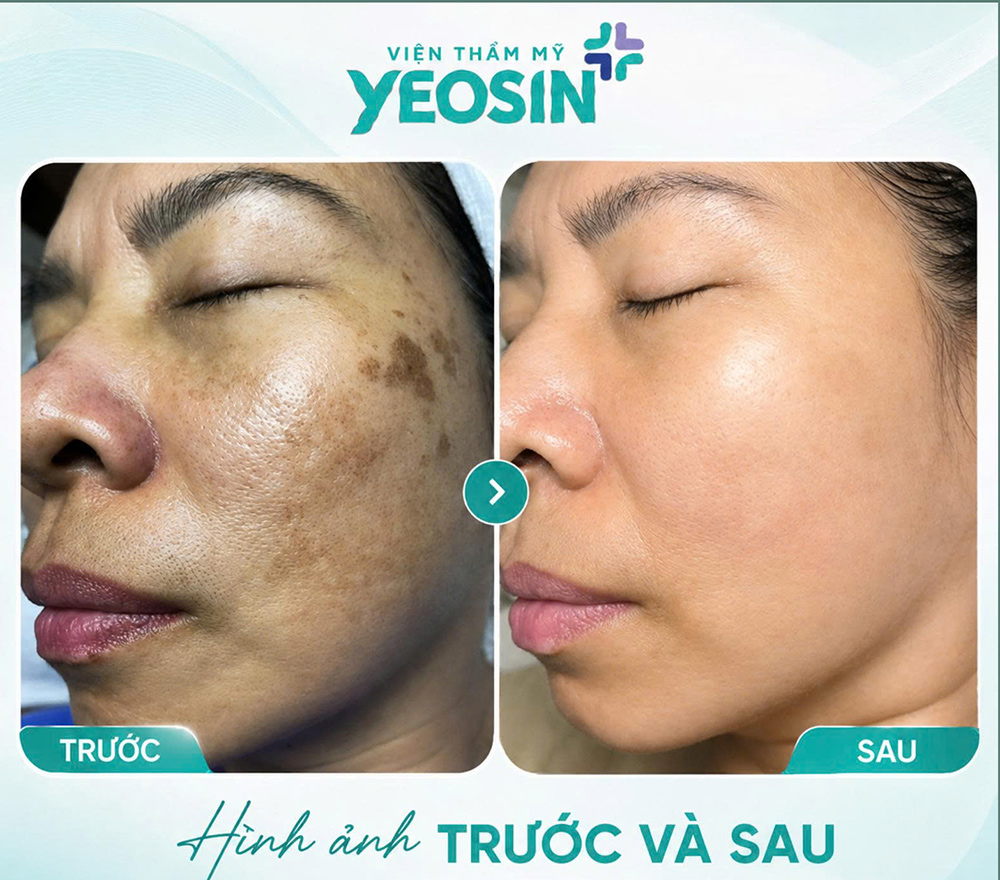 Điều trị nám bằng laser và những điều cần biết về laser nám 14 Hình ảnh trước và sau khi trị nám tàn nhang bằng laser tại Yeosin