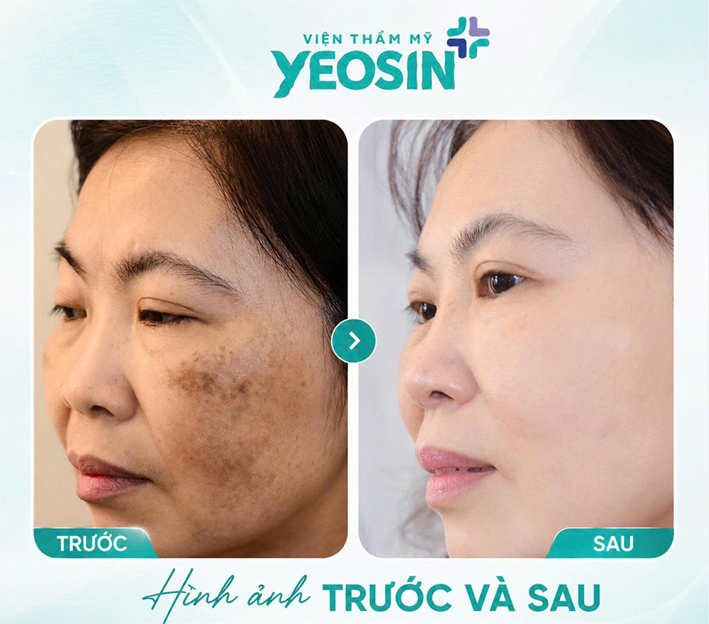 Điều trị nám bằng laser và những điều cần biết về laser nám 15 Hình ảnh trước và sau khi trị nám tàn nhang bằng laser tại Yeosin