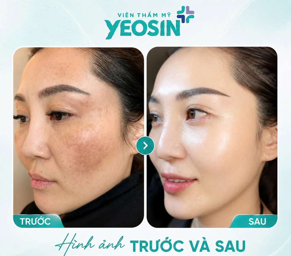 Điều trị nám bằng laser và những điều cần biết về laser nám 16 Hình ảnh trước và sau khi trị nám tàn nhang bằng laser tại Yeosin