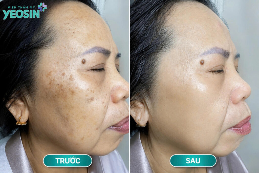 Hình ảnh trước và sau khi trị nám nội tiết tại Yeosin