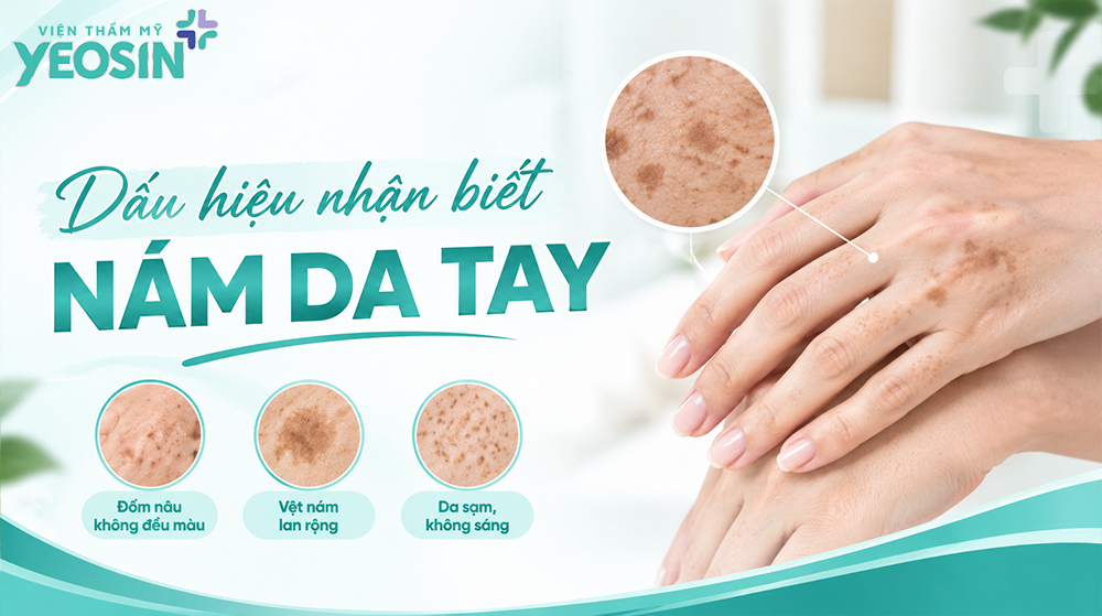 Nám da tay: Nguyên nhân và cách trị da tay bị nám 6 Nám da tay là gì? Dấu hiệu nhận biết