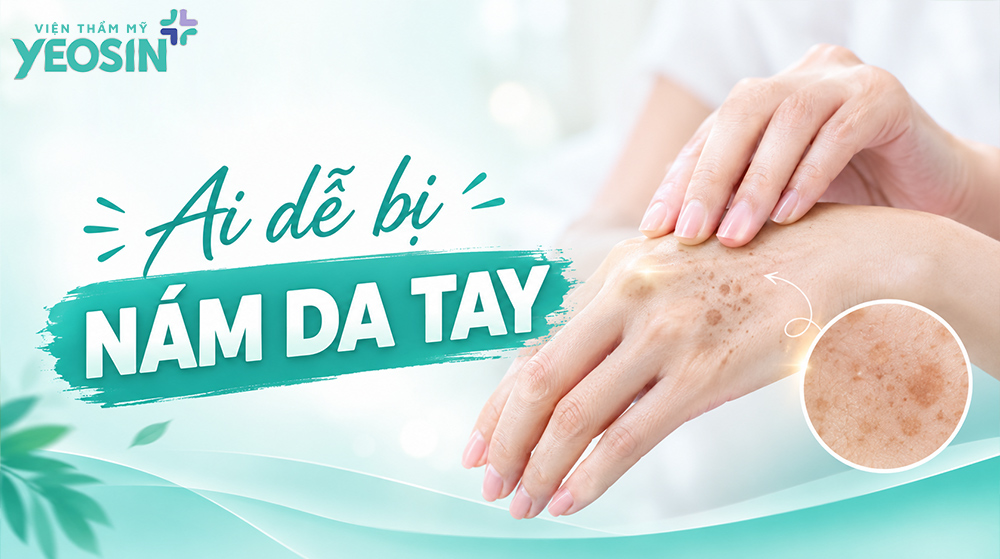 Nám da tay: Nguyên nhân và cách trị da tay bị nám 7 Ai dễ bị nám da tay?