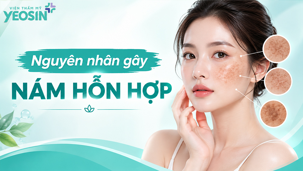 Nám hỗn hợp: Nguyên nhân và cách điều trị nám hỗn hợp 12 Nguyên nhân gây nám hỗn hợp