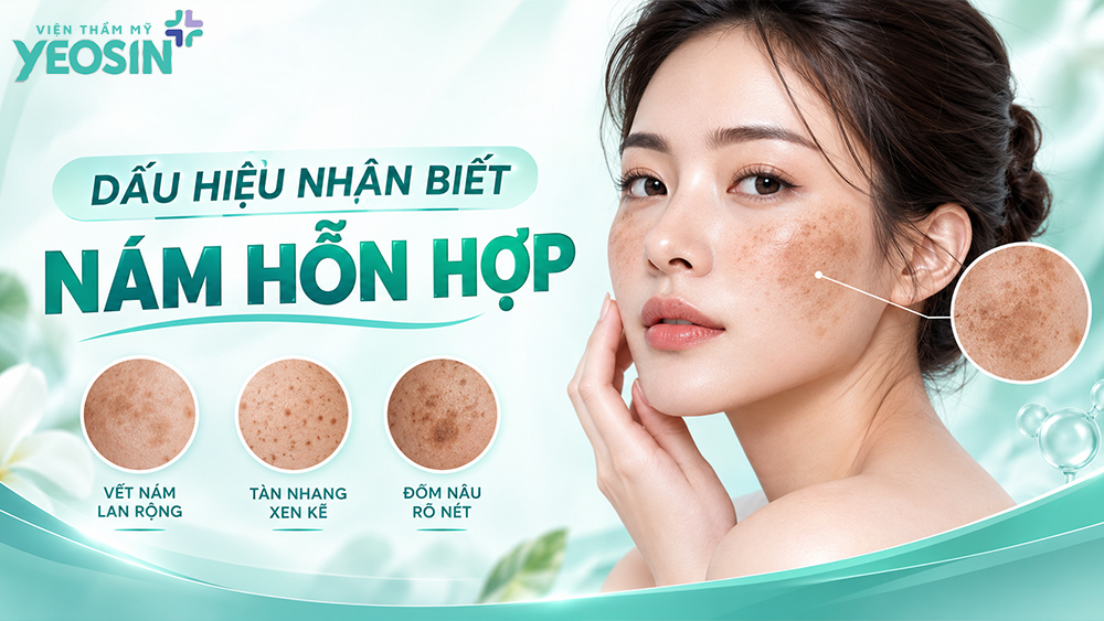 Nám hỗn hợp: Nguyên nhân và cách điều trị nám hỗn hợp 11 Nám hỗn hợp là gì? Dấu hiệu nhận biết