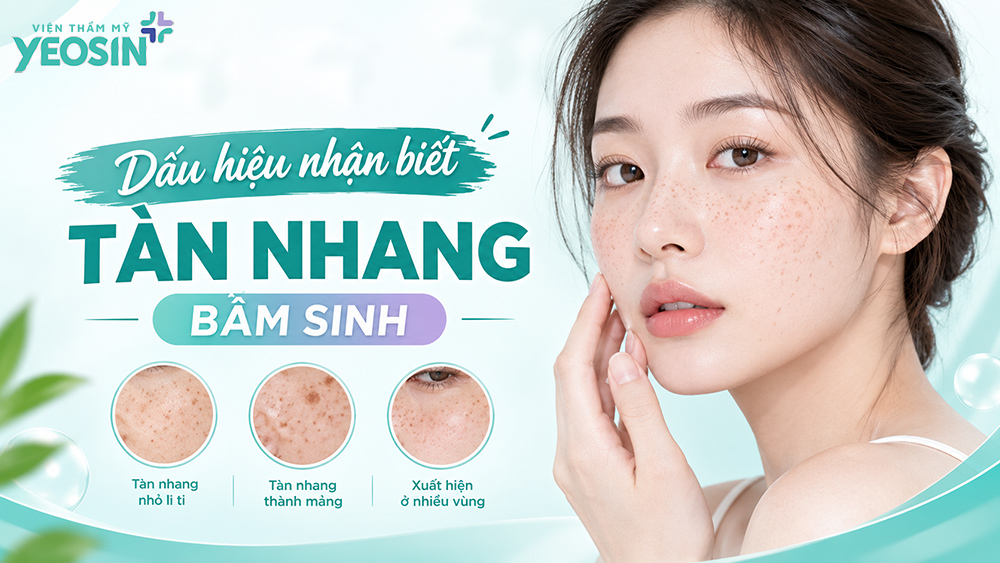 Tàn nhang bẩm sinh: Dấu hiệu, nguyên nhân và cách điều trị 8 Tàn nhang bẩm sinh là gì? Dấu hiệu nhận biết