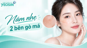 Da bị nám nhẹ 2 bên gò má