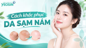 Da sạm nám