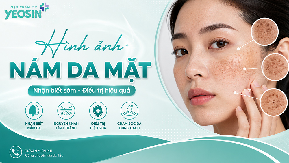 Hình ảnh nám da mặt: Nhận biết và hình ảnh trước sau khi trị nám