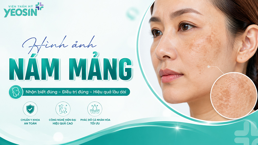 Hình ảnh nám da mặt: Nhận biết và hình ảnh trước sau khi trị nám 12 Hình ảnh nám mảng