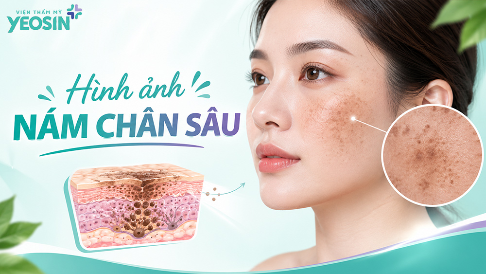 Hình ảnh nám da mặt: Nhận biết và hình ảnh trước sau khi trị nám 13 Hình ảnh nám chân sâu, nám đinh (nám đốm nâu)