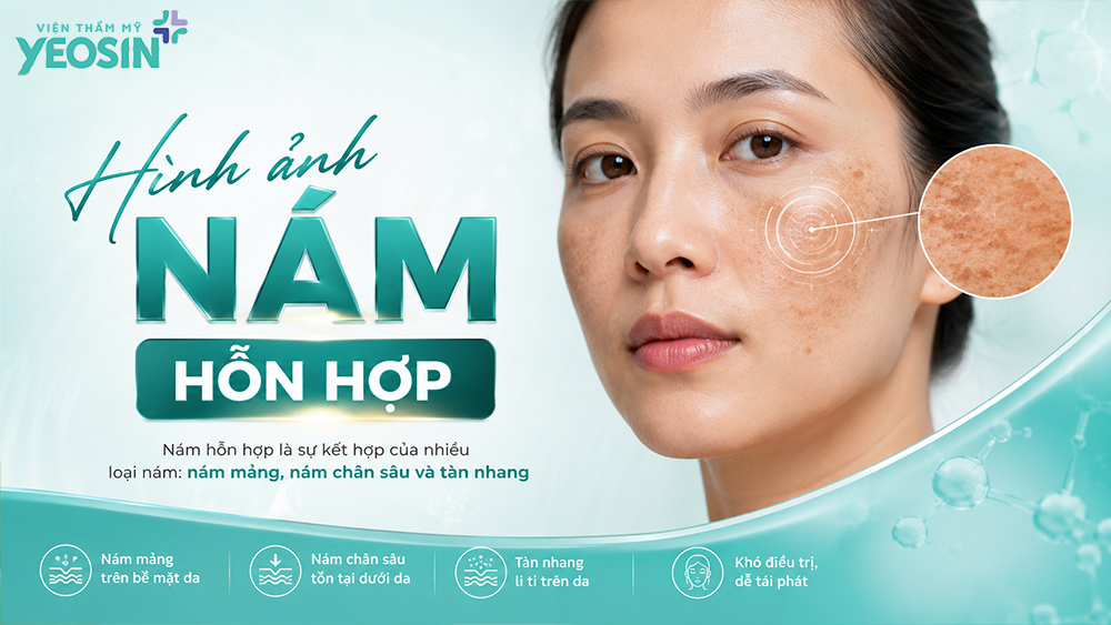 Hình ảnh nám da mặt: Nhận biết và hình ảnh trước sau khi trị nám 14 Hình ảnh nám hỗn hợp