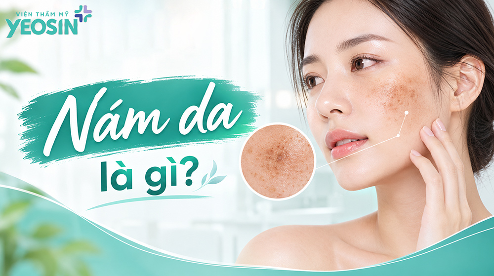 Nám da: Dấu hiệu, nguyên nhân và cách điều trị nám da 10 Nám da là gì?