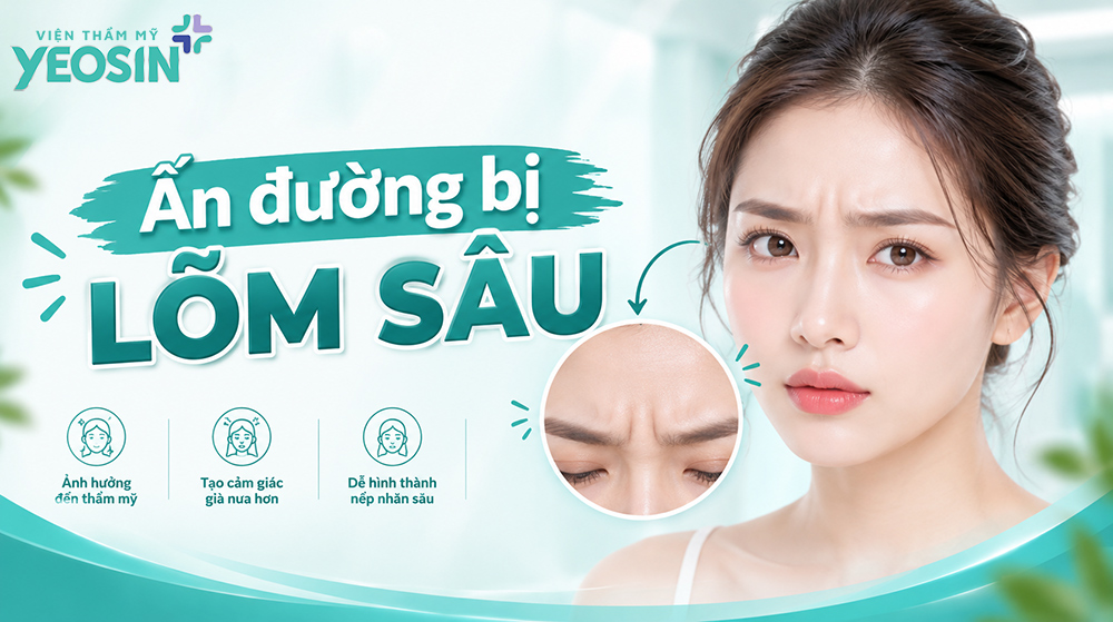 Ấn đường bị lõm