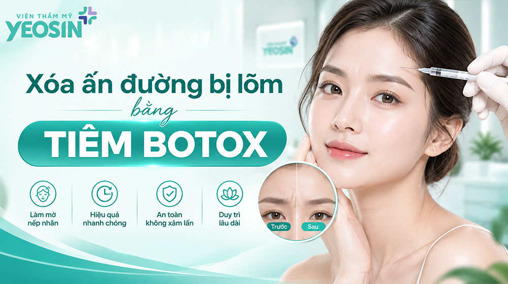 Ấn đường bị lõm là gì? Cách khắc phục ấn đường lõm sâu 14 Cách trị ấn đường lõm sâu bằng tiêm botox