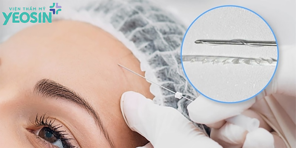 Cách xóa nếp nhăn cau mày bằng công nghệ căng chỉ sinh học Cách xóa nếp nhăn cau mày bằng công nghệ căng chỉ sinh học