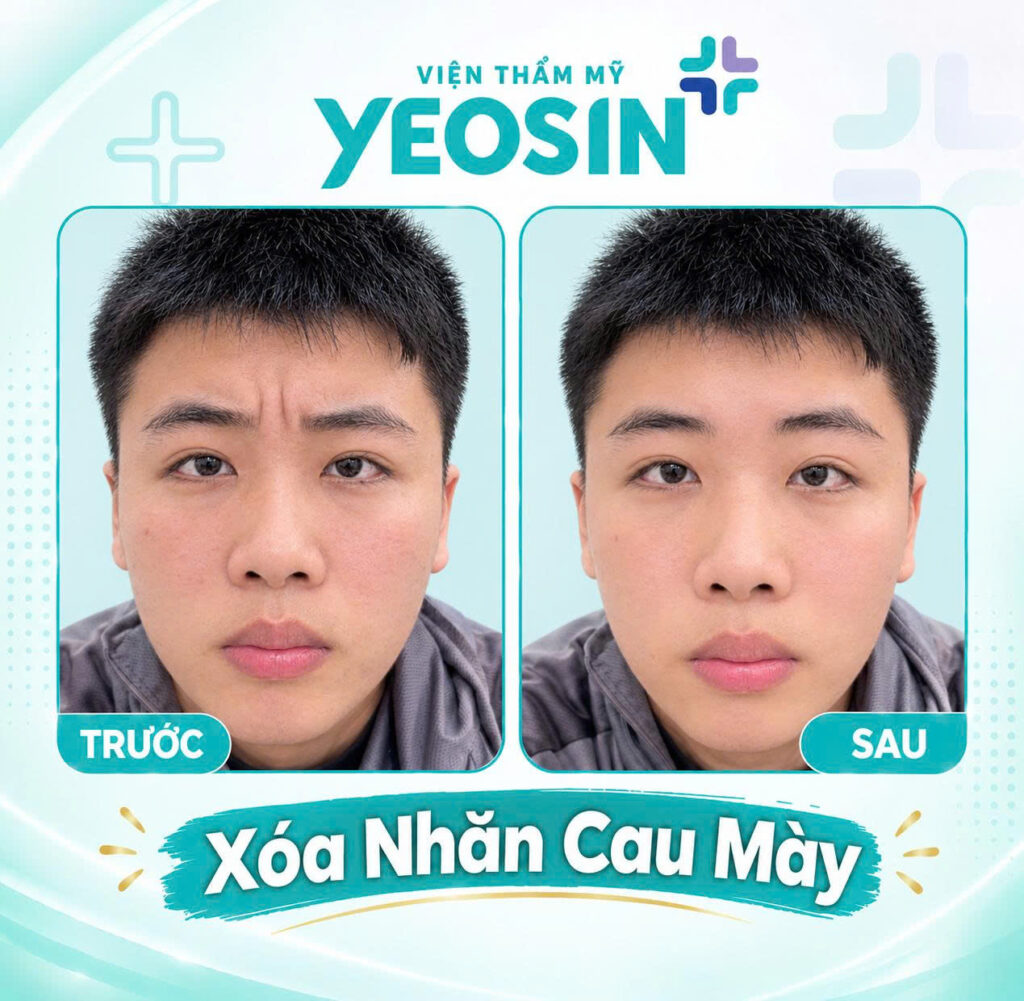 Hình ảnh trước và sau khi xóa nếp nhăn ấn đường tại Yeosin