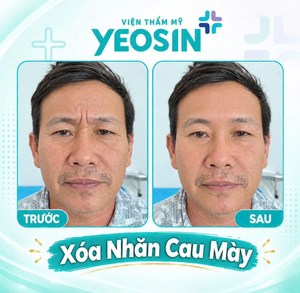 Hình ảnh trước và sau khi xóa nếp nhăn ấn đường tại Yeosin