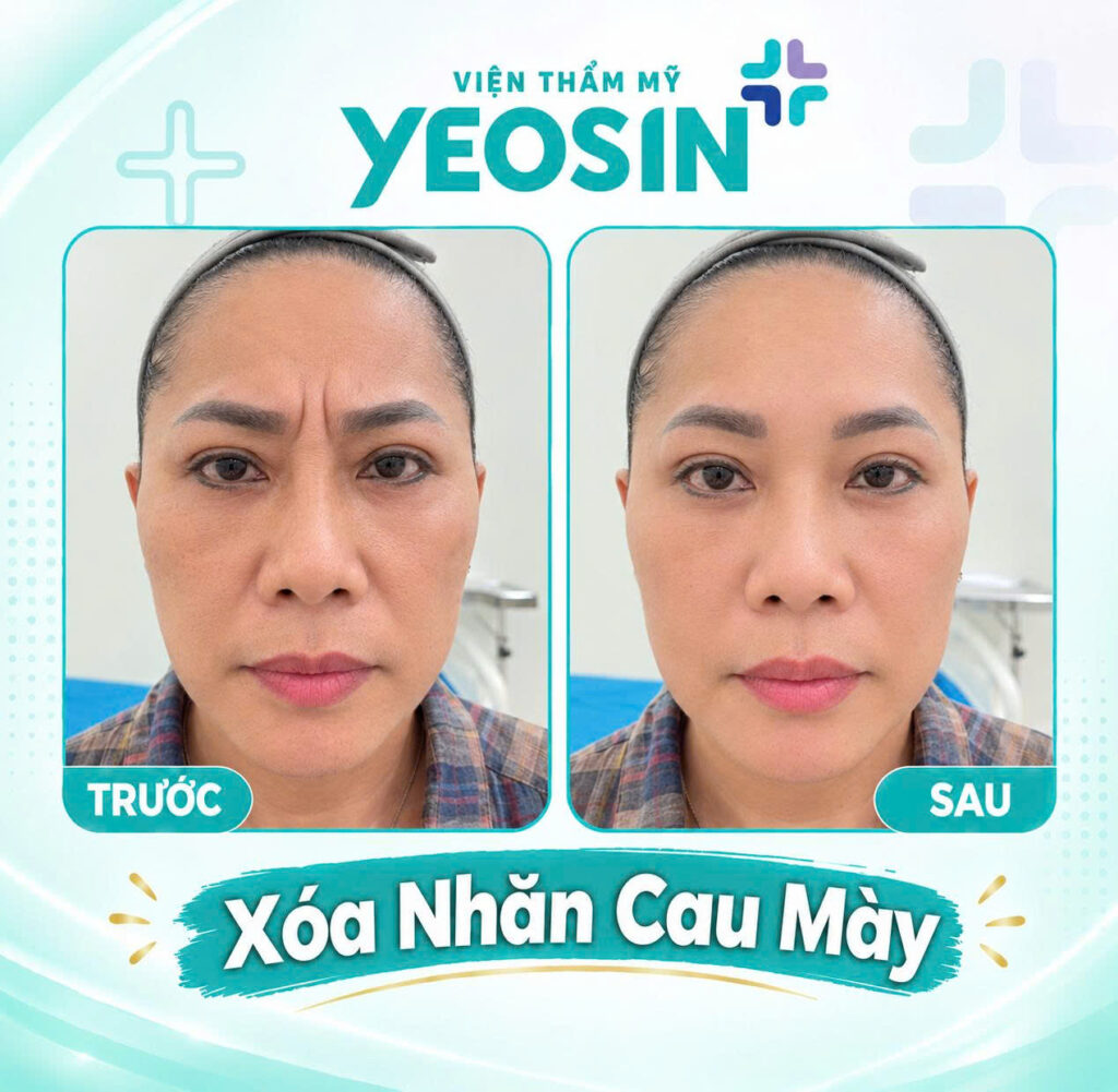 Hình ảnh trước và sau khi xóa nếp nhăn cau mày tại Yeosin