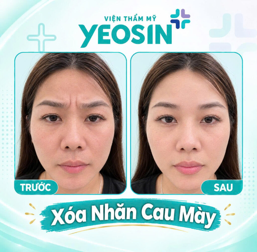 Hình ảnh trước và sau khi xóa nếp nhăn ấn đường tại Yeosin