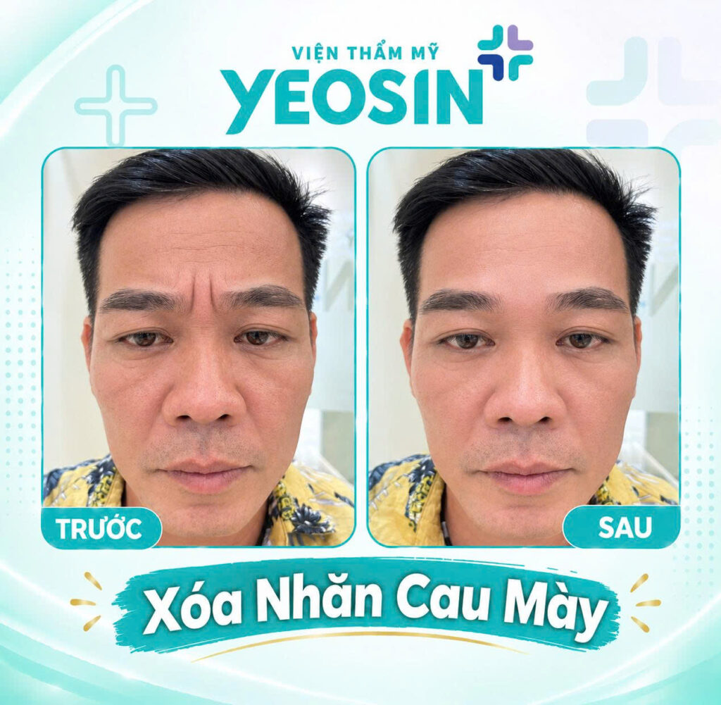 Hình ảnh trước và sau khi xóa nếp nhăn ấn đường tại Yeosin