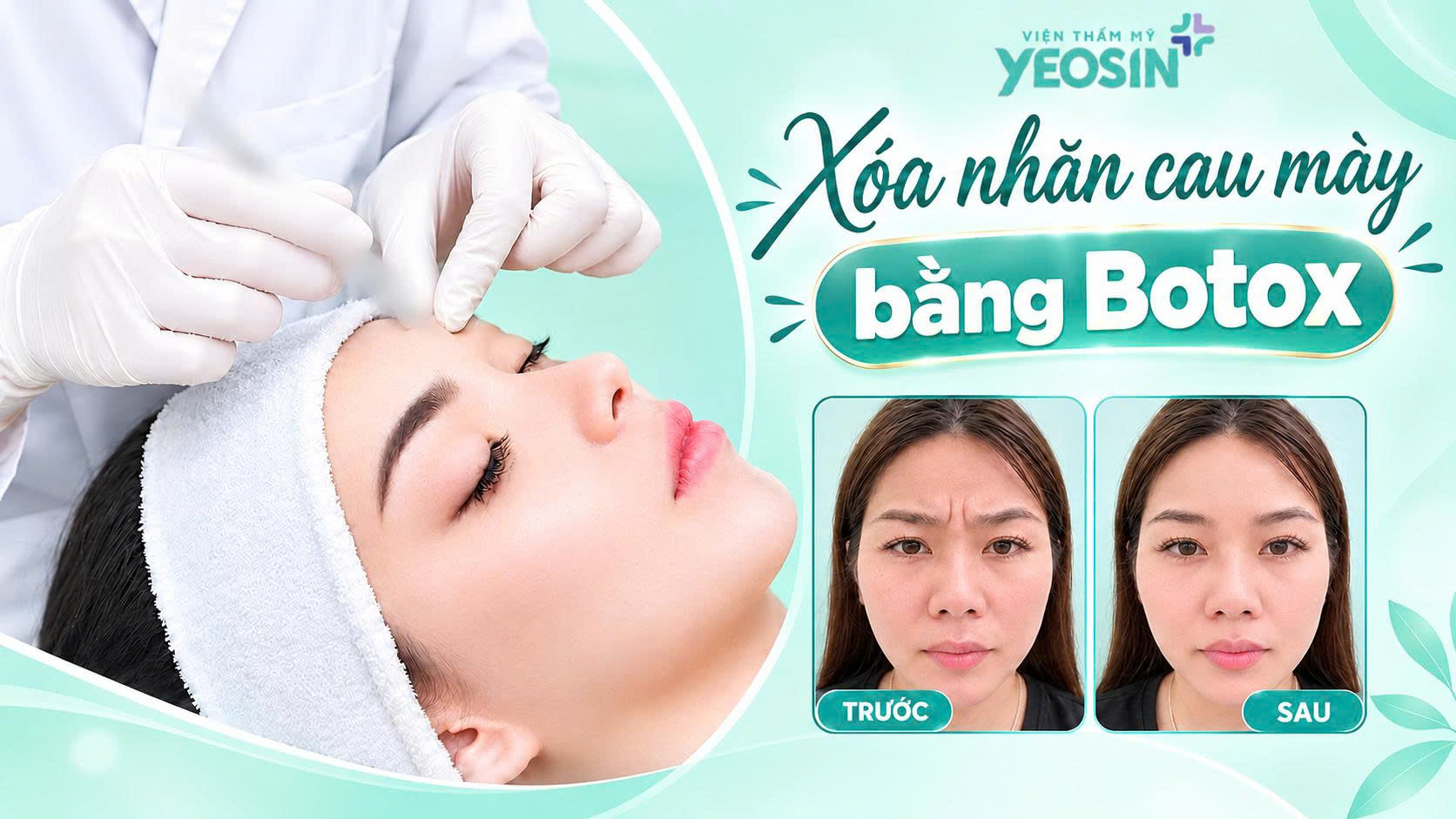 Xóa nhăn cau mày - Xóa nếp nhăn cau mày bằng tiêm botox