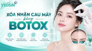 Xóa nhăn cau mày - Xóa nếp nhăn cau mày bằng tiêm botox