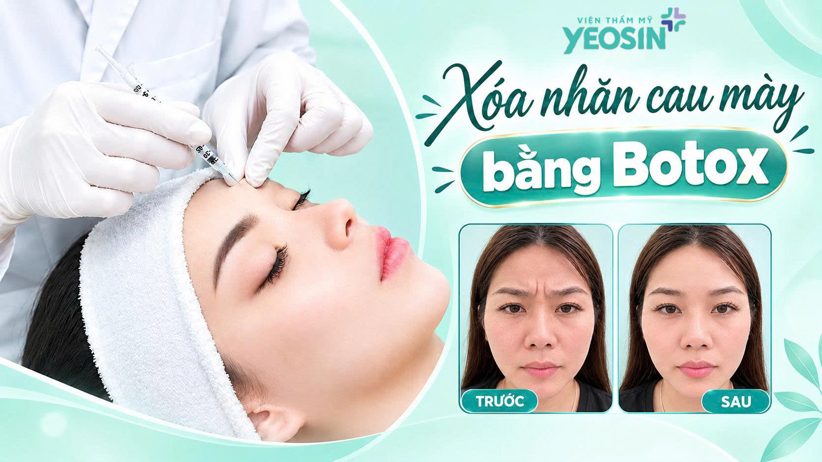 Xóa nhăn cau mày - Xóa nếp nhăn cau mày bằng tiêm botox